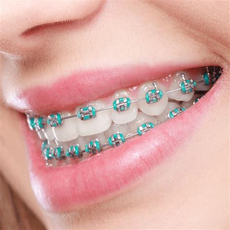 metal ortho brackets|traditional metal braces for adults.